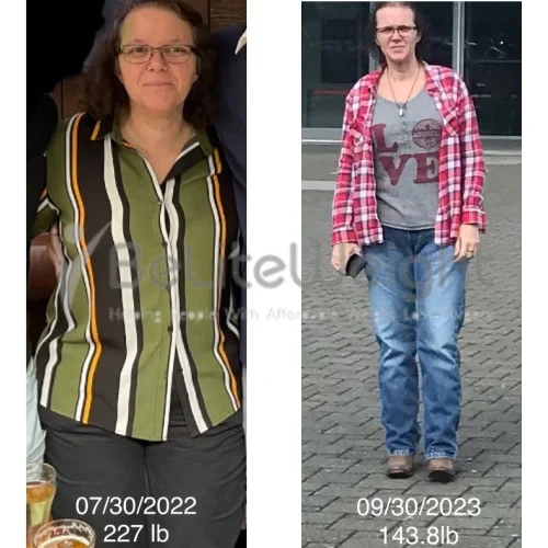 RNY Gastric Bypass Before and After